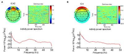 Localizing Epileptic Foci Using Simultaneous EEG-fMRI Recording: Template Component Cross-Correlation